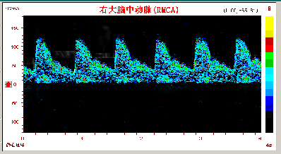 超聲經顱多普勒腦動脈硬化頻譜圖.jpg