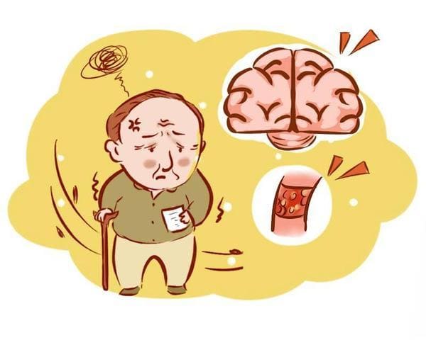 腦血栓的發生前兆有哪些