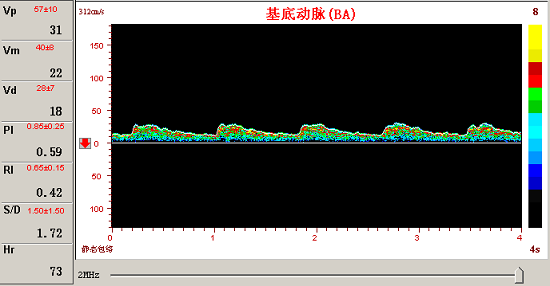 經顱多普勒對椎─基底動脈的