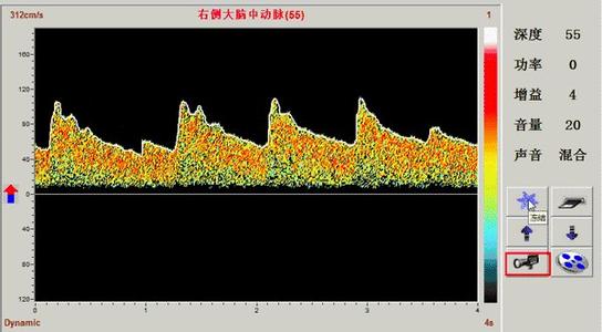 正常腦血管多普勒頻譜及各血流參數