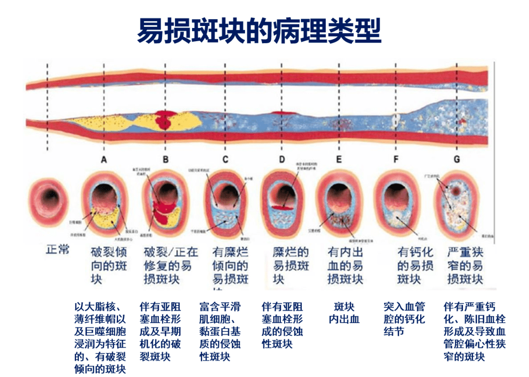 易損斑塊是缺血性卒中發生的獨立危險因素